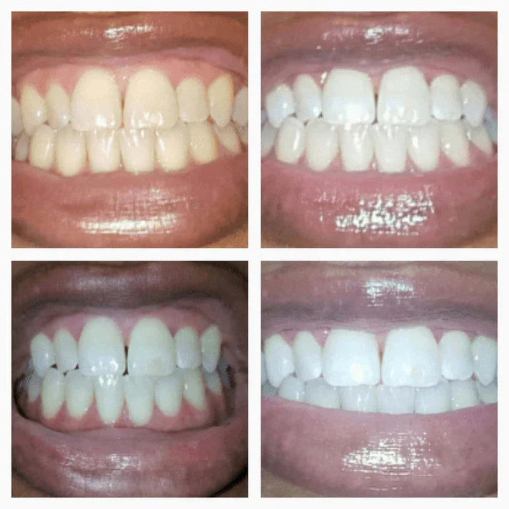 Waresluck™ Teeth Whitening Pen