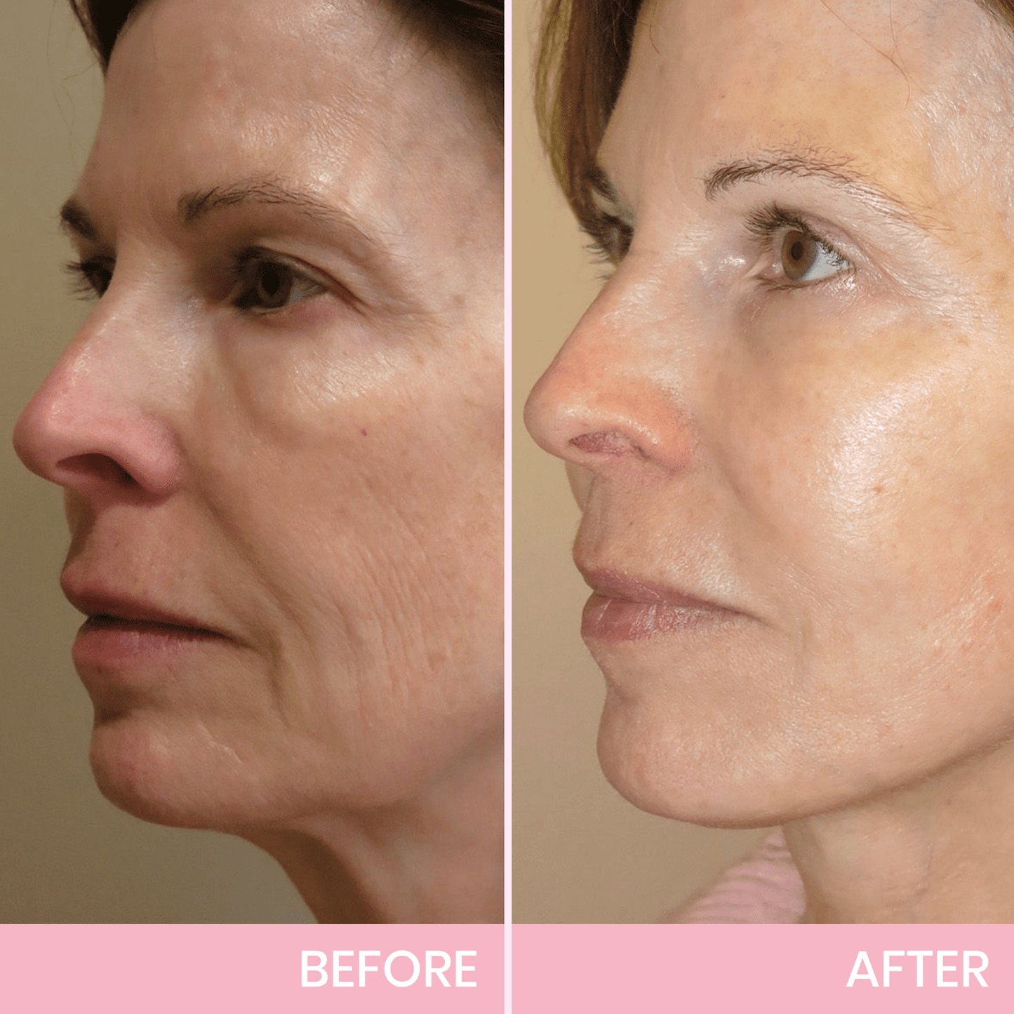 💖🎁Last Day 50% OFF-Aweiya ™ V-Face Lifting Invisible Adhesive Tape