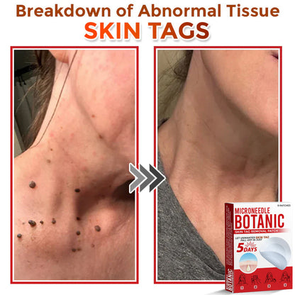 Removal Patch | Removes Moles, Warts, Skin Flaws & Pigmentation