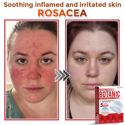 Removal Patch | Removes Moles, Warts, Skin Flaws & Pigmentation