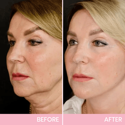 💖🎁Last Day 50% OFF-Aweiya ™ V-Face Lifting Invisible Adhesive Tape