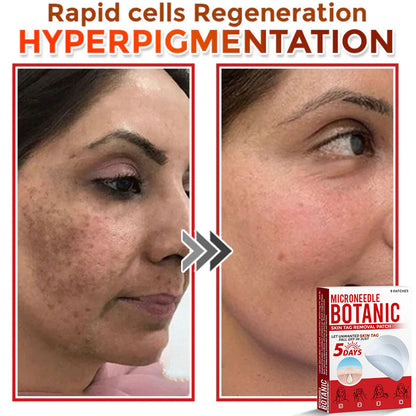 Removal Patch | Removes Moles, Warts, Skin Flaws & Pigmentation