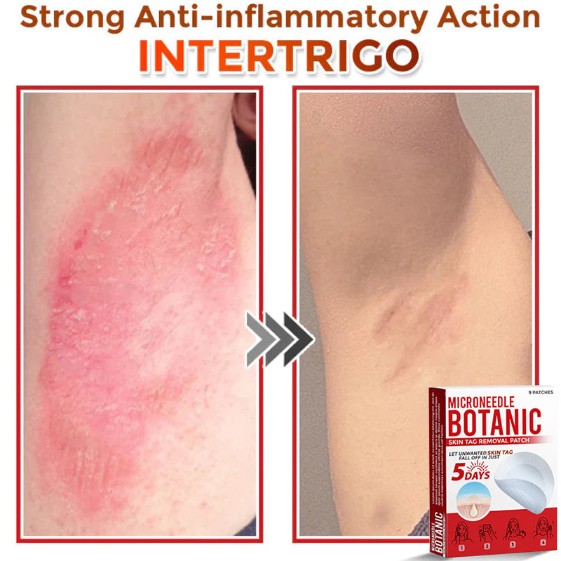 Removal Patch | Removes Moles, Warts, Skin Flaws & Pigmentation
