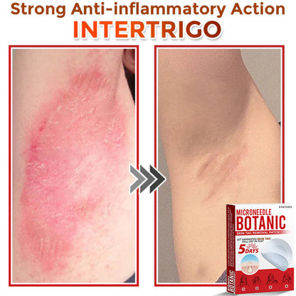 Removal Patch | Removes Moles, Warts, Skin Flaws & Pigmentation