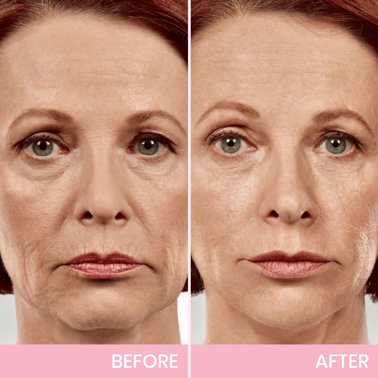 💖🎁Last Day 50% OFF-Aweiya ™ V-Face Lifting Invisible Adhesive Tape
