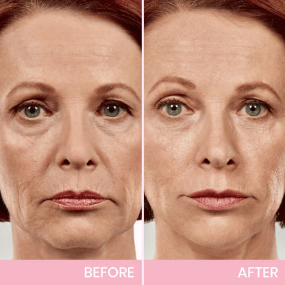 💖🎁Last Day 50% OFF-Aweiya ™ V-Face Lifting Invisible Adhesive Tape