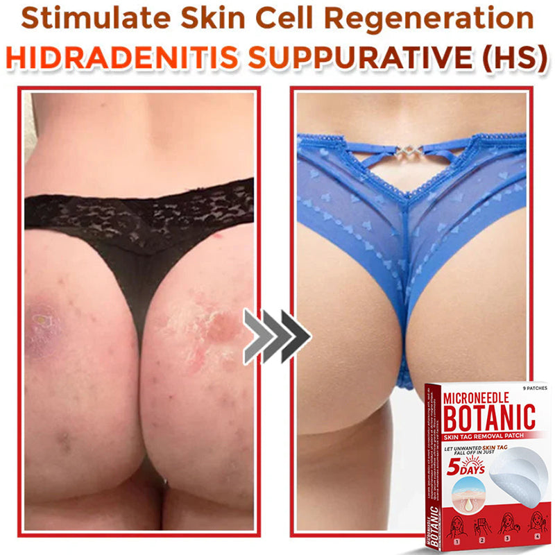 Removal Patch | Removes Moles, Warts, Skin Flaws & Pigmentation