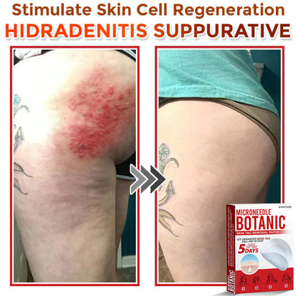 Removal Patch | Removes Moles, Warts, Skin Flaws & Pigmentation