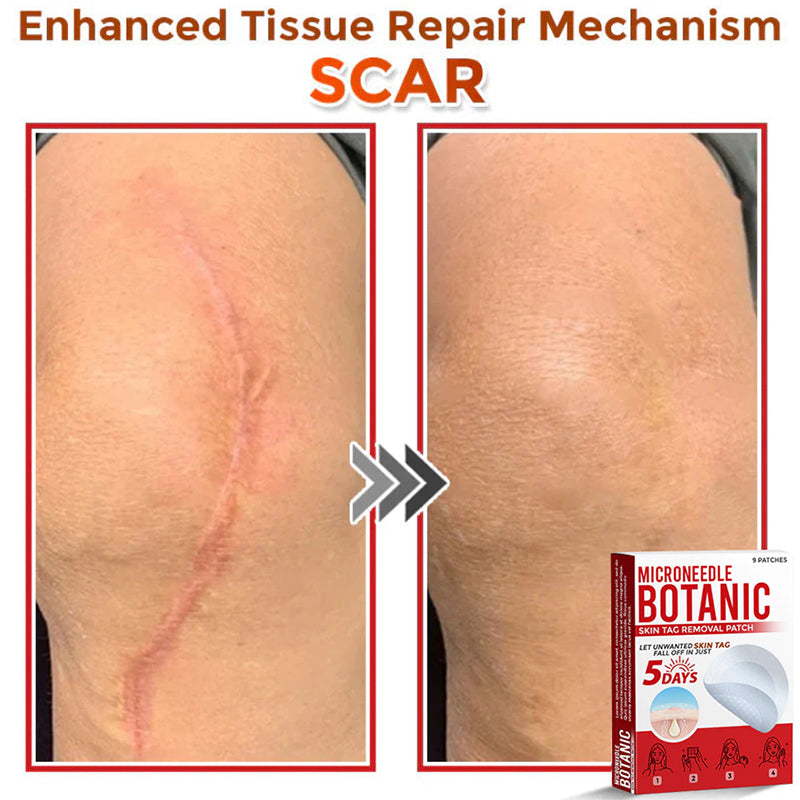 Removal Patch | Removes Moles, Warts, Skin Flaws & Pigmentation