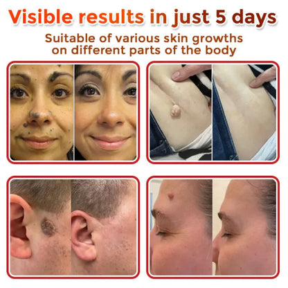 Removal Patch | Removes Moles, Warts, Skin Flaws & Pigmentation